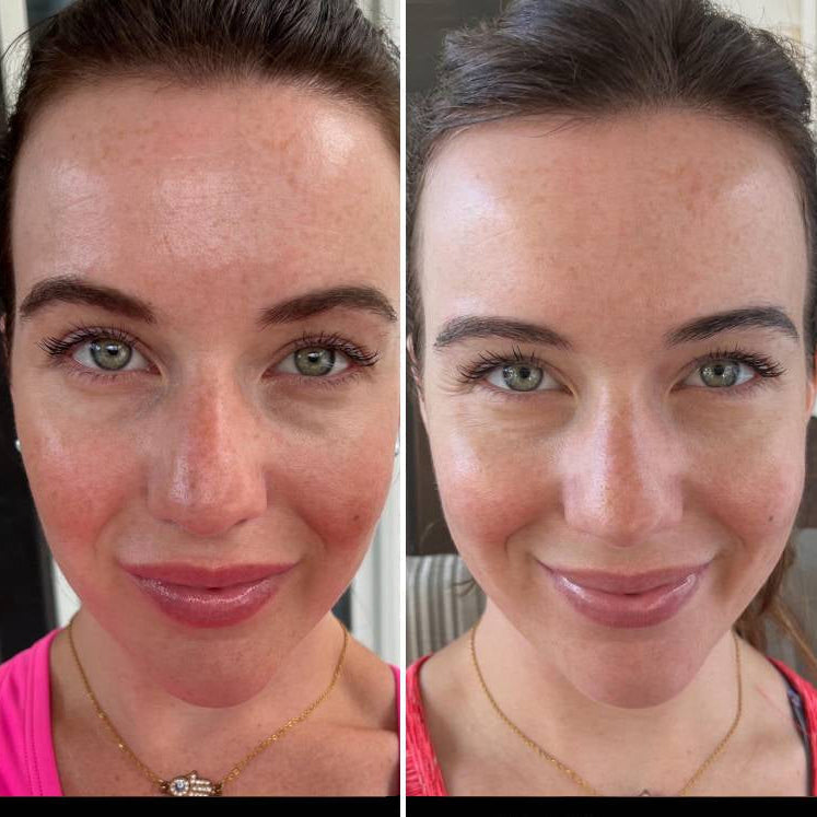 LED Face Mask Light Therapy Skincare Device